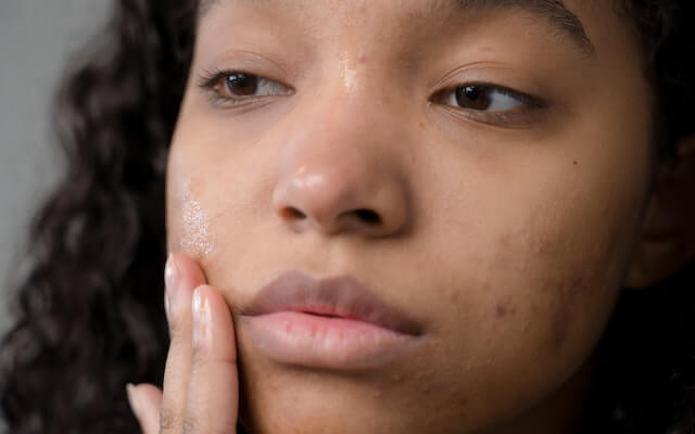 Acne flare-ups Subtle Changes Caused by Pre-Menstrual Syndrome